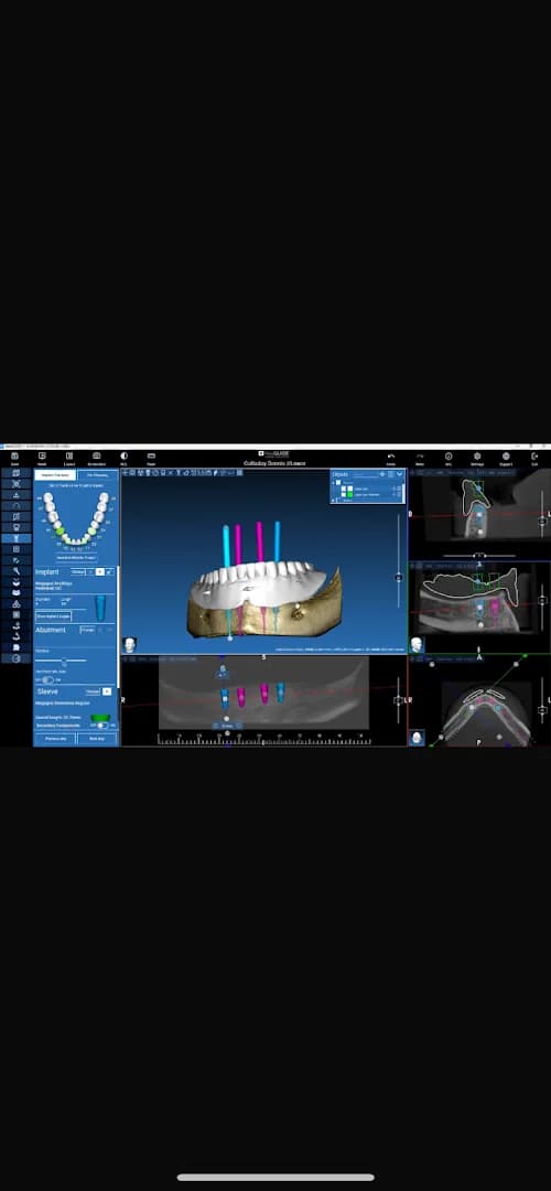Digital Implant Planning