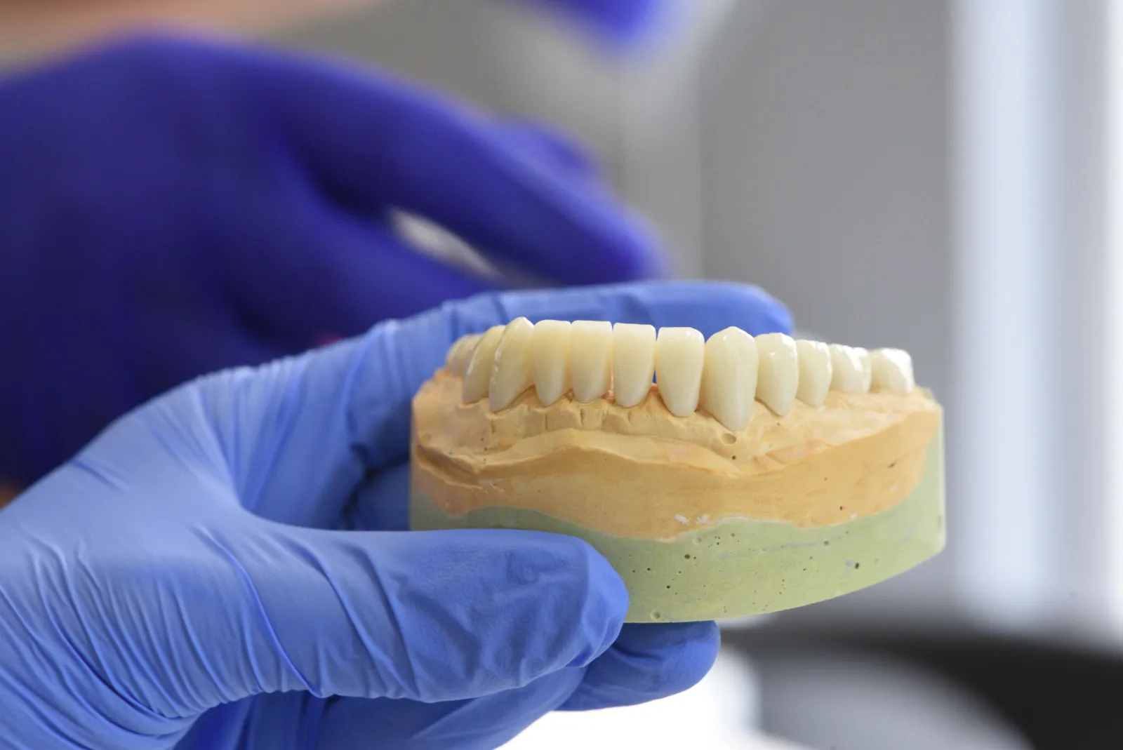 Do Veneers Ruin Your Natural Teeth?